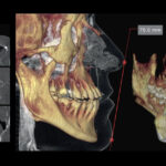 CBCT