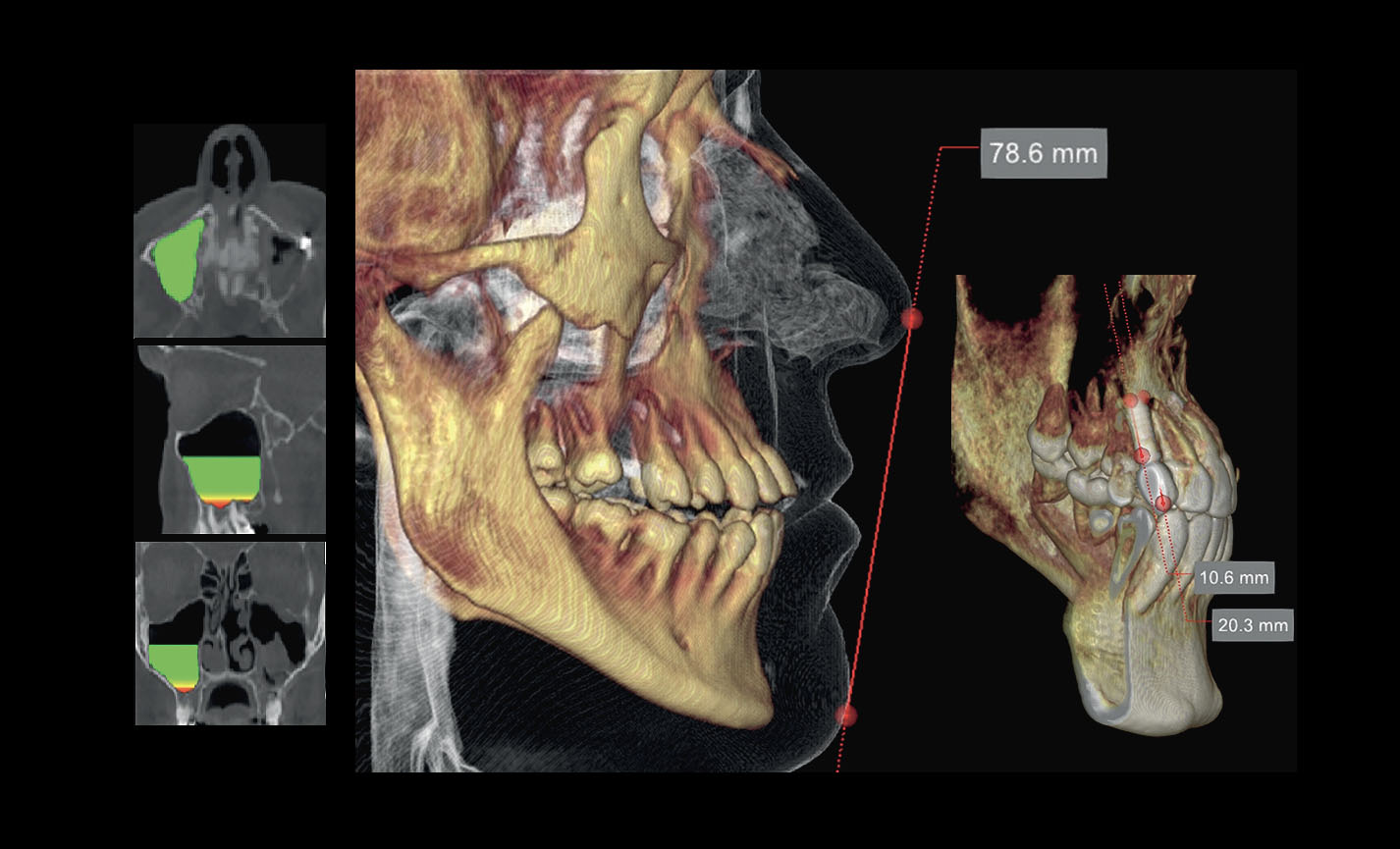 CBCT